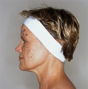side view of a woman with her face marked for plastic surgery